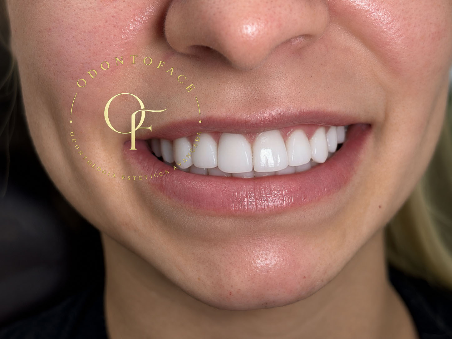 Sorriso depois das facetas em resina